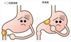 食昼食後の胃の痛み、原因は胃潰瘍？