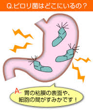 胃潰瘍の原因となるピロリ菌